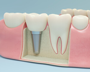 3D render of human gums model with teeth and dental implant. Medical dental illustration.  