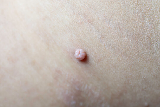 Skin tag or acrochordon or soft fibroma or mole. macro photo. Papilloma virus or bump, dermatology problem on skin concept.