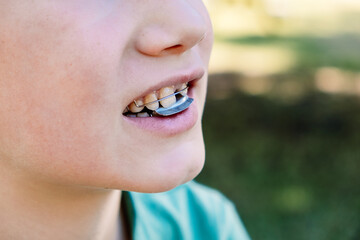 Child with orthodontic appliance to correct malocclusion, forward bite