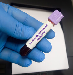 Blood sample for Hereditary Hemochromatosis gene mutation test, a disorder in which the body can...