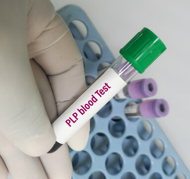 Test tube with blood sample for PLP (Pyridoxal 5-Phosphate) blood test, for vitamin B6 deficiency diagnosis. Vitamin B6 test.