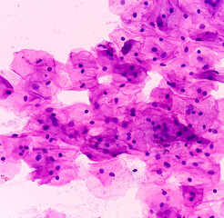 Pap's smear. Microscopic examination of pap smear showing inflammatory smear with reactive cellular changes. NILM. cervical cancer diagnosis.