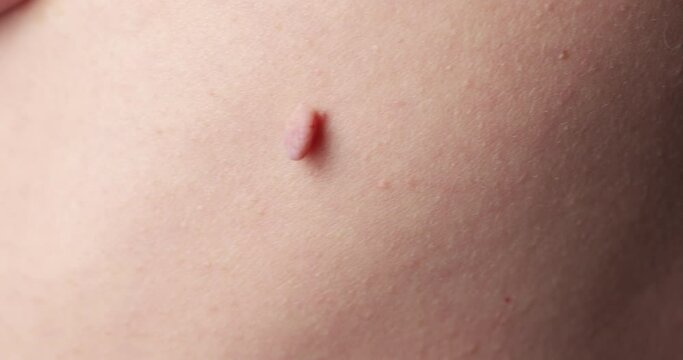 Close-up of Neoplasm or Birthmark on the Skin of an adult male. Pigmented spots on the back of a man. Skin with moles and Acne.