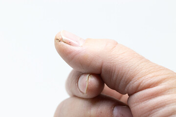 Obraz premium cracked skin at thumb tip of a woman hand