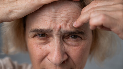 Obraz premium Unhappy elderly woman pointing at wrinkles on her forehead. 