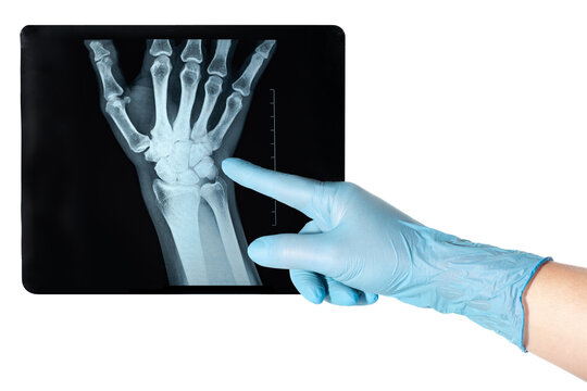 Hand in medical blue glove holds X-ray of the side of a woman`s points uncommon traumatic wrist injury