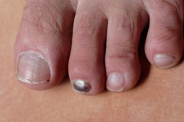 A toenail has turned black, blood has pooled under the nail