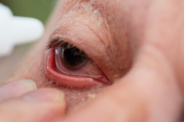 A man is having eye drops put in his eye after cataract surgery