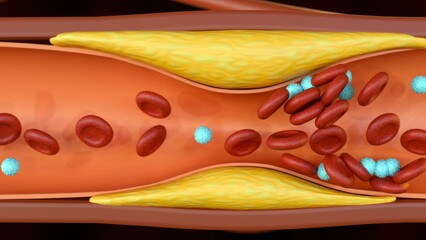 3d rendering of plaque formation of Cholesterol in artery (atherosclerosis)