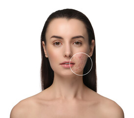 Woman before and after cosmetology procedure on white background. Zoomed area showing problem skin