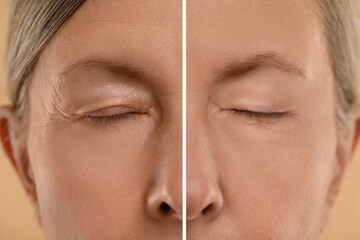 Aging skin changes. Woman showing face before and after rejuvenation, closeup. Collage comparing...
