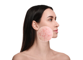 Woman before and after cosmetology procedure on white background. Zoomed area showing problem skin