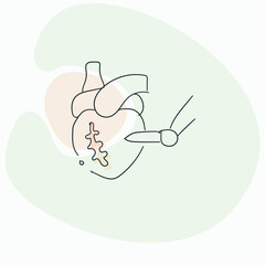 CABG stands for Coronary Artery Bypass Grafting