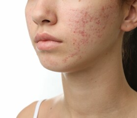 Obraz premium Teenage girl with acne problem on white background, closeup