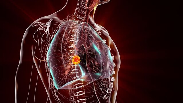 A human body with transparent skin showcasing lung cancer, 3D animation.