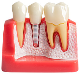 Dental implant, artificial tooth roots into jaw, root canal of dental treatment, gum disease on...