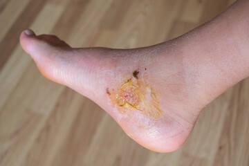 A close-up view of a persons foot, showing dried yellow substance from a burst and healed blister.