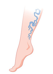 Varicose veins. Blue blood vessel visible through the skin, abnormally swollen leg. Vascular disease diagnostic and treatment. Venous insufficiency medical disease