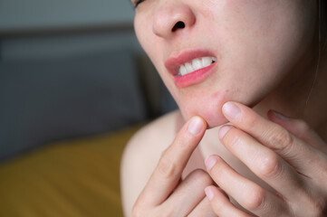 Asian woman having pain because of acne occur on her chin. The deeper and larger the pimple, the...