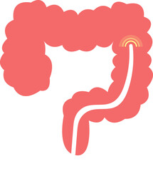 colon cancer. colonoscope in the colon. polyp removal. 2d illustration. 대장용종, 담낭석, 담석, 담낭염, 담석증, 대장내시경, 위내시경, 아이콘, 일러스트 벡터