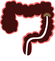 colon cancer. colonoscope in the colon. polyp removal. 2d illustration. 대장용종, 담낭석, 담석, 담낭염, 담석증, 대장내시경, 위내시경, 아이콘, 일러스트 벡터