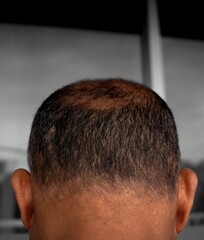 man's head seen from behind, starting to lose hair, Man with hair problems