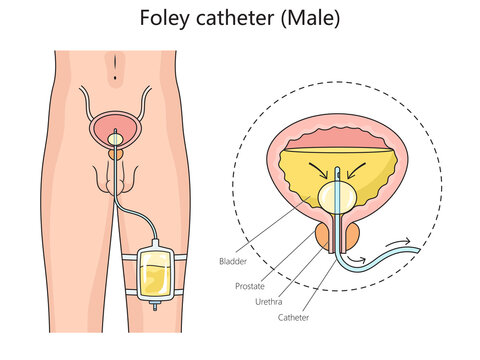 Male foley urinary catheter structure diagram hand drawn schematic raster illustration. Medical science educational illustration