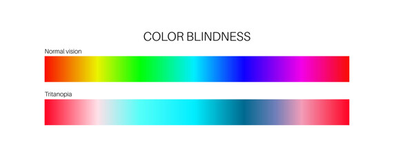 Tritanopia and tritanomaly