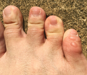 The friction blisters on the little toe. The vesicle on the skin of pinky toe.