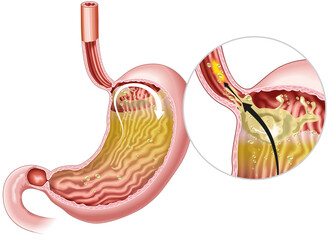 Gastrophageal reflux disease (GERD). Illustration