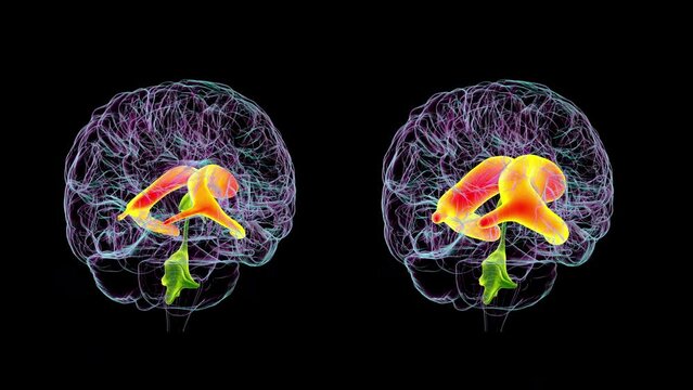Enlarged (hydrocephalus, right side of the animation) and normal (left side) lateral ventricles of the brain, 3D animation.