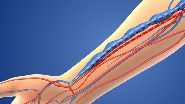 Medical animation of the Arteriovenous fistula