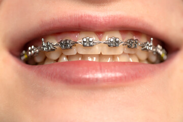 Beautiful macro shot of natural white teeth with braces. Dental care photo. Beauty woman smile with ortodontic accessories.