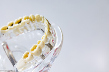 Fototapeta na wymiar Dental model present common dental disease such as caries, wisdom tooth