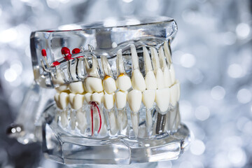 Dental tooth implant titanium prosthetic dentists model.