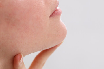 Rosacea and Food allergy concept. Young woman with sensitive skin irritation close up. Soft focus image