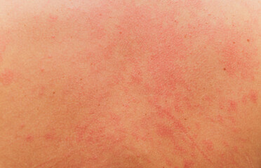 allergic rash on the body of the patient.