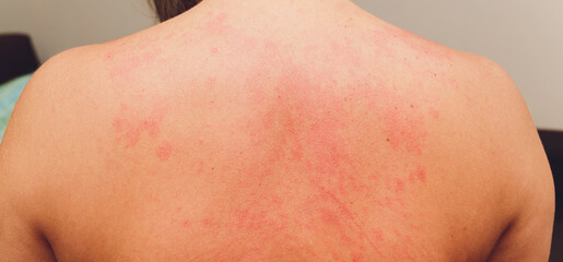 allergic rash on the body of the patient.