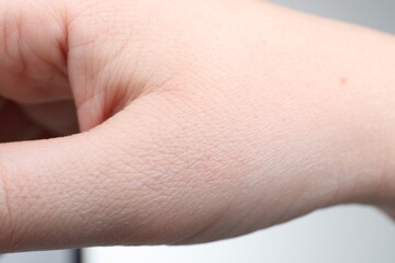 Woman with dry skin on hand against light background, closeup