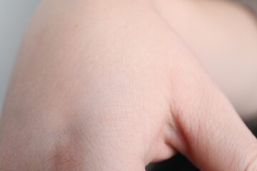 Woman with dry skin on hand, closeup