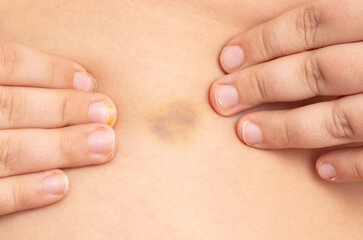 Close-up of a bruise on a person's skin