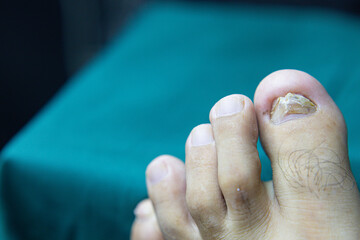 Close-up of big toenail ruptured and infected with fungus