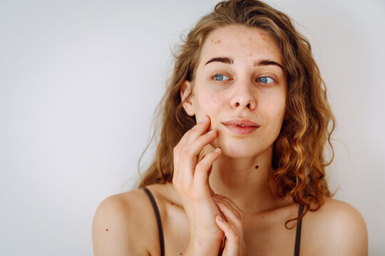 Young woman with problem skin. Life with acne. Problem skin prone to rashes and acne, scars. Dermatology and cosmetology concept.