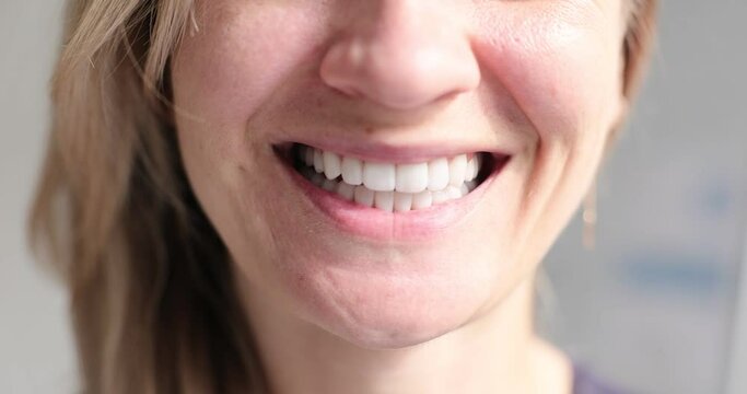 Young woman with snow white smile closeup 4k movie. Installation of implants and veneers concept