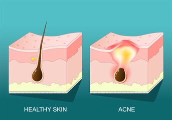 Acne. Cross section of a human skin with pimple