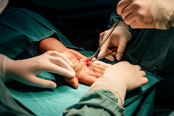 Medical team, surgeons and assistants,  healthcare professionals, using sterile surgical instruments, hand surgery in hospital's operating room.
