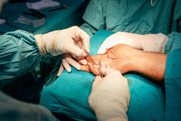 Skilled surgeon hands, in sterile gloves, performs precise suturing on a patient's hand ,...
