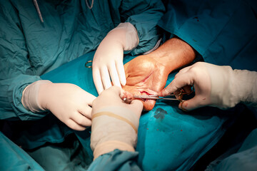Skilled surgeon hands, in sterile gloves, performs precise suturing on a patient's hand , showcasing the professionalism and precision of healthcare in the medical industry.	
