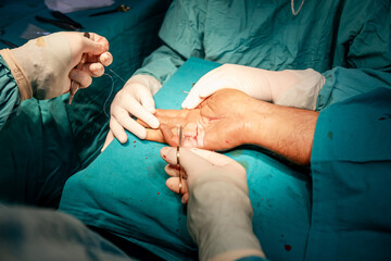 Skilled surgeon hands, in sterile gloves, performs precise suturing on a patient's hand ,...