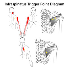 Infraspinatus Trigger Point Diagram